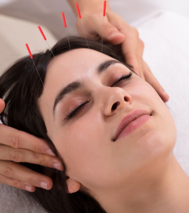 woman with acupuncture needles in face